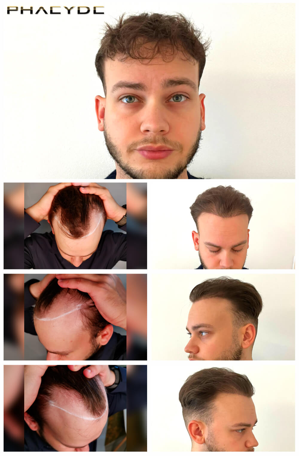 i/hair-transplantation/before-after-photos/hair-transplant-before-after-daniel-phaeyde-clinic.jpg