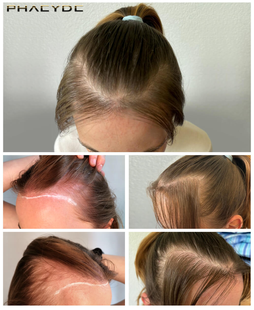 i/hair-transplantation/before-after-photos/hair-transplant-before-after-ivana-phaeyde-clinic.jpg