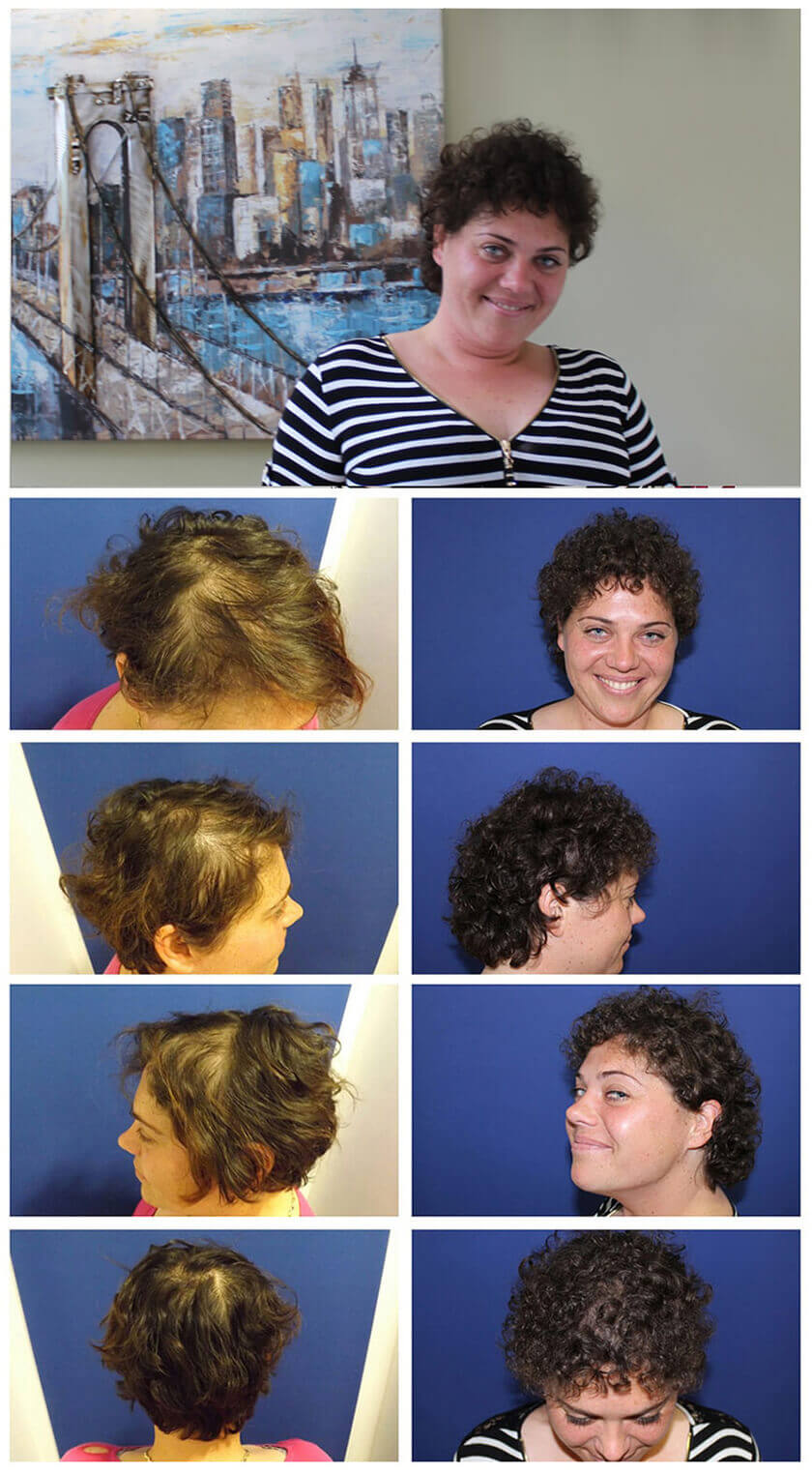 Hair Restoration Nainen