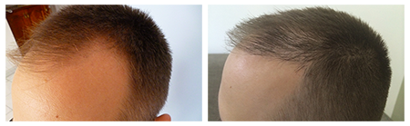 PHAEYDE Clinic Hair Transplant Results